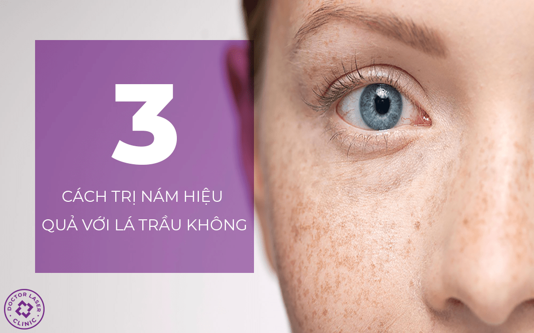 3 cách trị nám