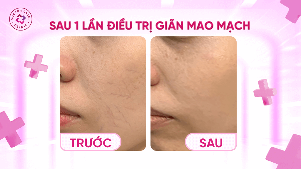 Trước sau khi điều trị giãn mao mạch