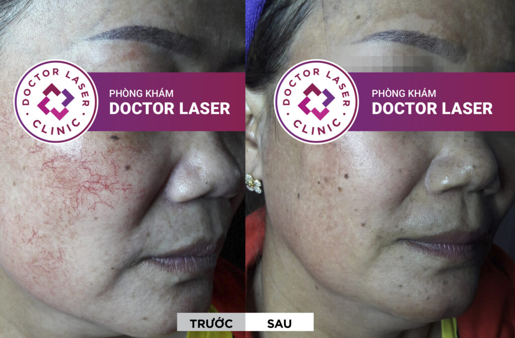 Hình ảnh trước - sau điều trị giãn mao mạch mặt của chị Tuyết tại Doctor Laser
