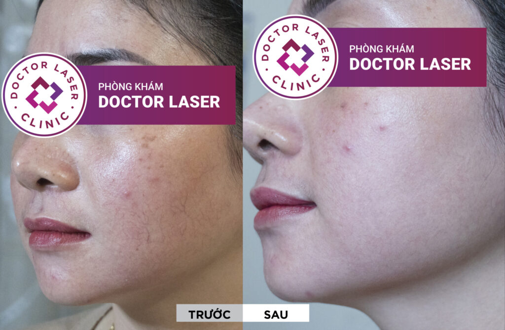 Hình ảnh trước - sau điều trị giãn mao mạch mặt của chị Trang tại Doctor Laser