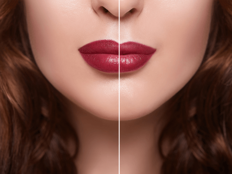 Tiêm filler là phương pháp làm đẹp đang “làm mưa làm gió” đối với giới trẻ vì sự tiện lợi, an toàn và hiệu quả