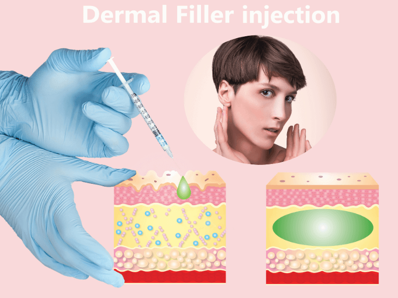 Làm sao để tránh tiêm filler bị nhức?