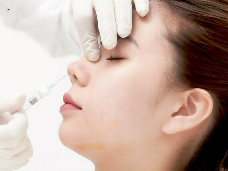 Tiêm filler mũi là một trong những phương pháp làm đẹp không phẫu thuật phổ biến nhất