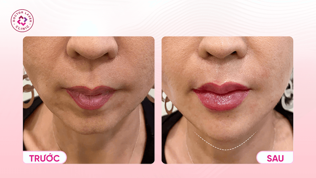 Trước và sau khi tiêm filler tại Doctor Laser