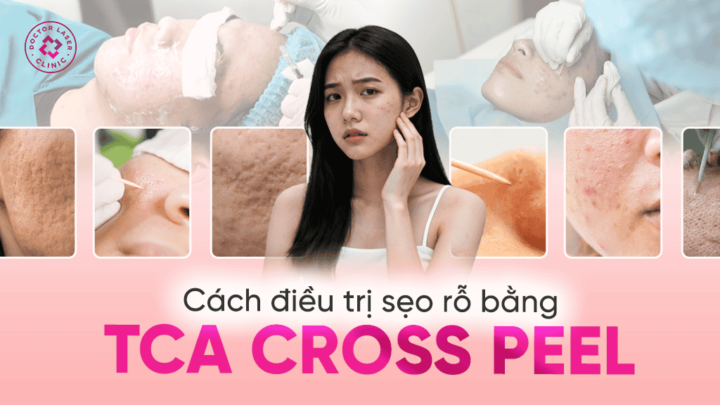 Cách điều trị sẹo rỗ bằng TCA Cross Peel