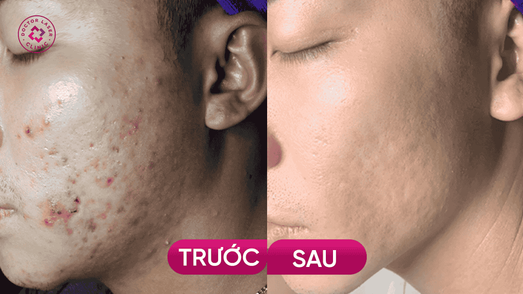 Hình ảnh khách hàng điều trị sẹo tại Doctor Laser