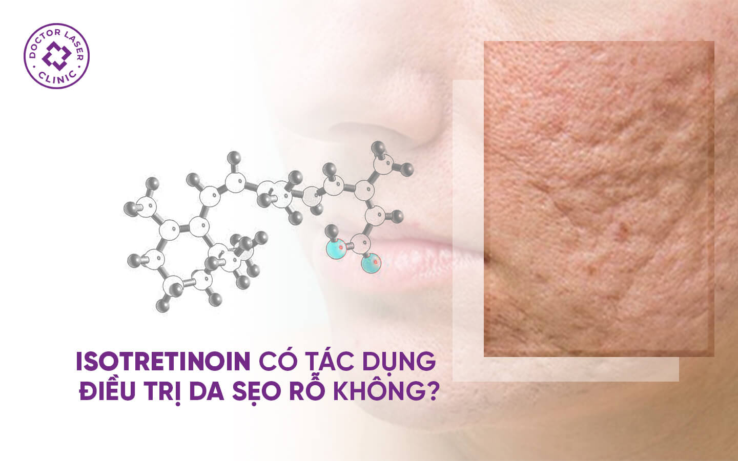 Isotretinoin trị sẹo rỗ có điều trị sẹo rỗ được không?