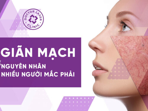 NGUYÊN NHÂN BỊ GIÃN MẠCH NHIỀU NGƯỜI MẮC PHẢI