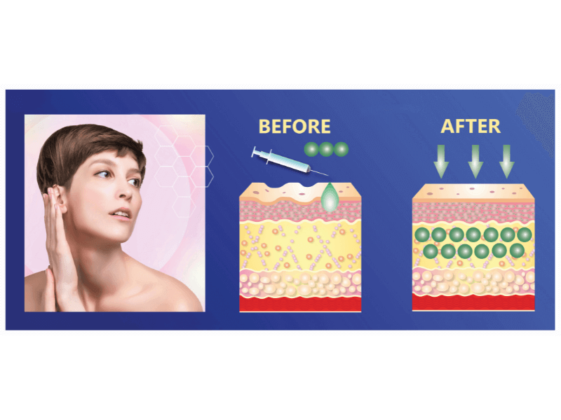 Collagen được sản sinh nhiều hơn khi được tiêm PRP