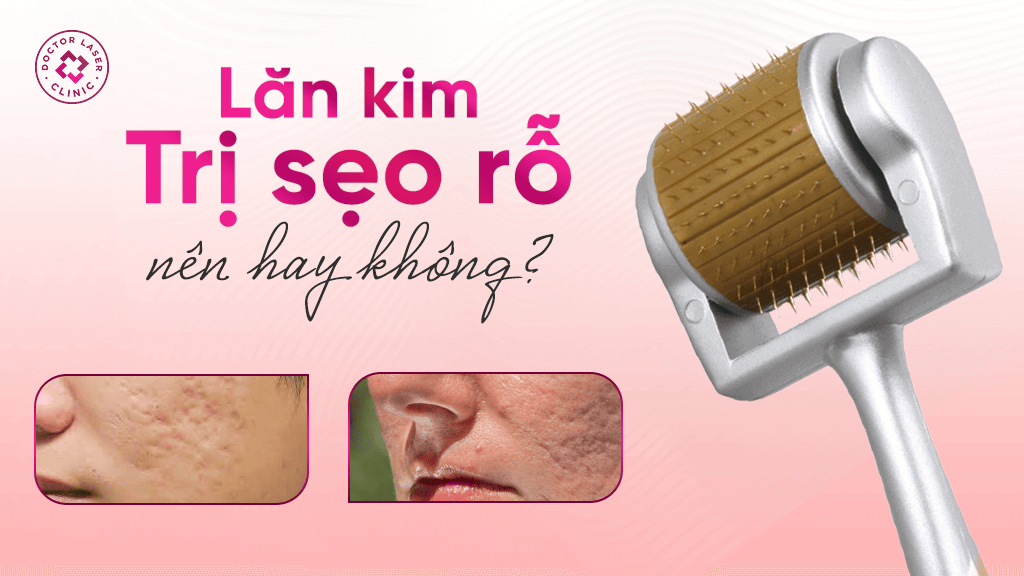 Lăn kim trị sẹo rỗ nên hay không