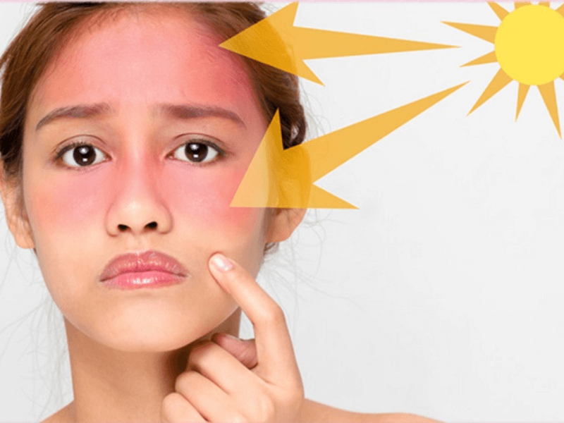 Nếu không được kem chống nắng bảo vệ, da rất dễ bị tăng sắc tố
