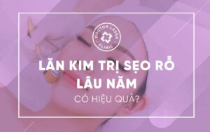 lăn kim trị sẹo rỗ lâu lăm