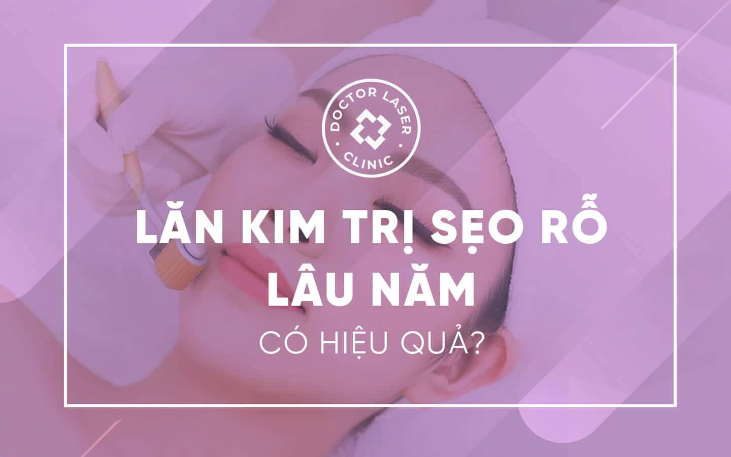 lăn kim trị sẹo rỗ lâu lăm