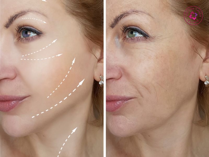 Sự khác biệt giữa trước và sau khi tiêm botox