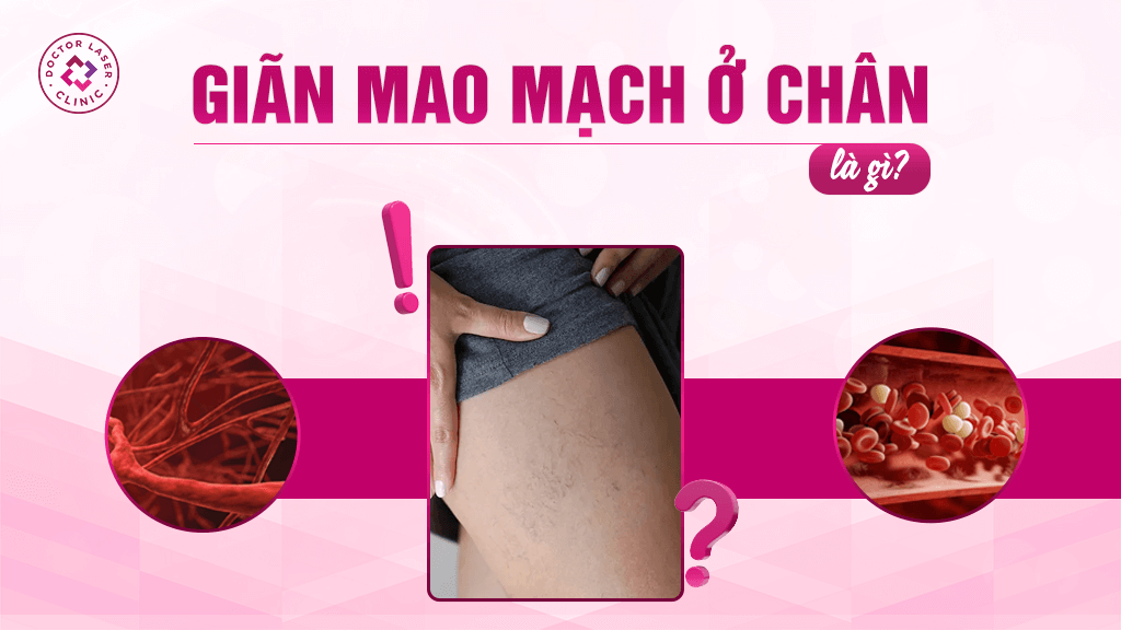 Giãn mao mạch chân là gì?