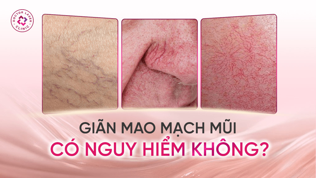Giãn mao mạch mũi có nguy hiểm không?