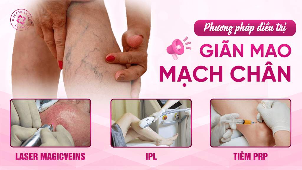 Phương pháp điều trị giãn mao mạch chân