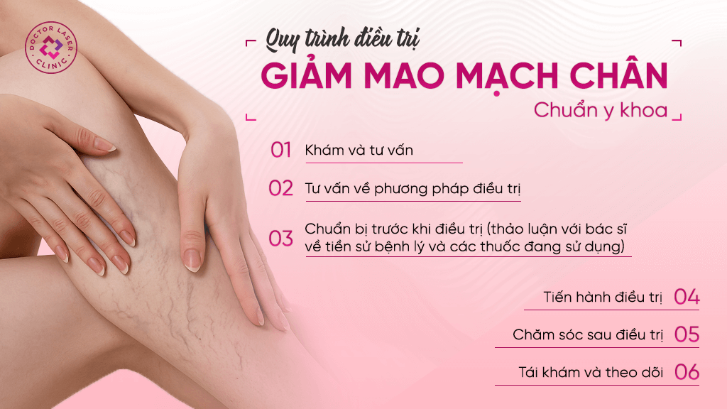 Quy trình điều trị giãn mao mạch chân chuẩn y khoa