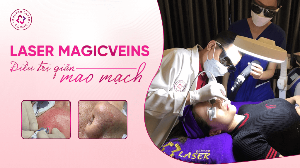 Laser MagicVeins điều trị giãn mao mạch