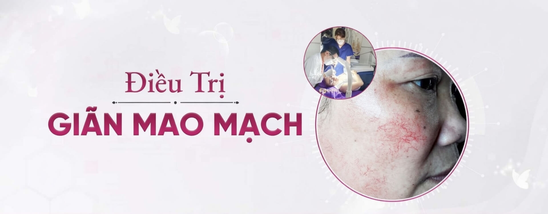 banner dịch vụ điều trị giãn mao mạch desktop banner dịch vụ điều trị giãn mao mạch desktop