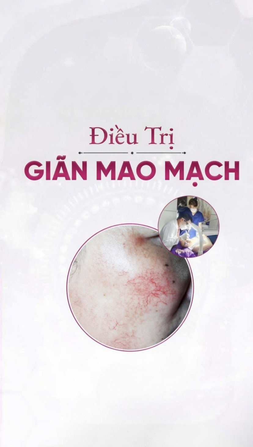 banner dịch vụ điều trị giãn mao mạch mobile banner dịch vụ điều trị giãn mao mạch mobile