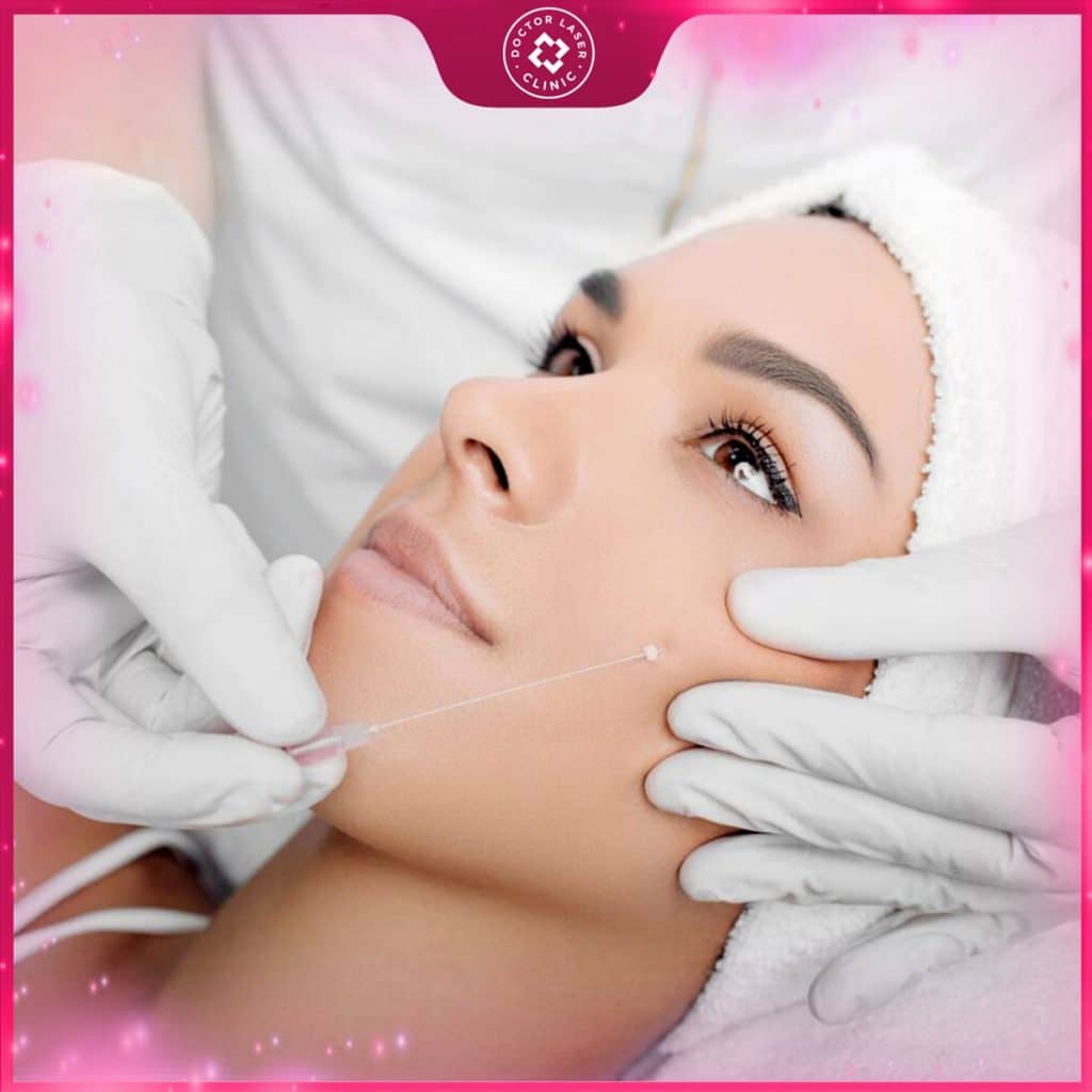 cang-chi-collagen-doctor-laser căng chỉ collagen doctor laser