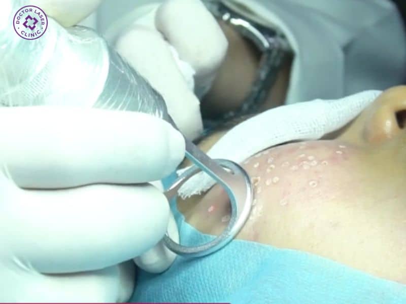 Bác sĩ tại Doctor Laser dùng laser CO2 Fractional điều trị sẹo rỗ 