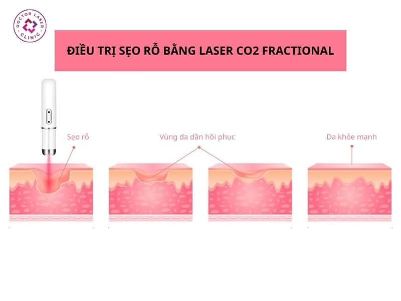Bề mặt da khi điều trị sẹo rỗ bằng laser CO2 Fractional