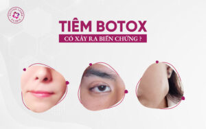 Các biến chứng xảy ra khi tiêm botox