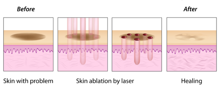 laser co2 fractional hoạt động như thế nào trong điều trị sẹo rỗ