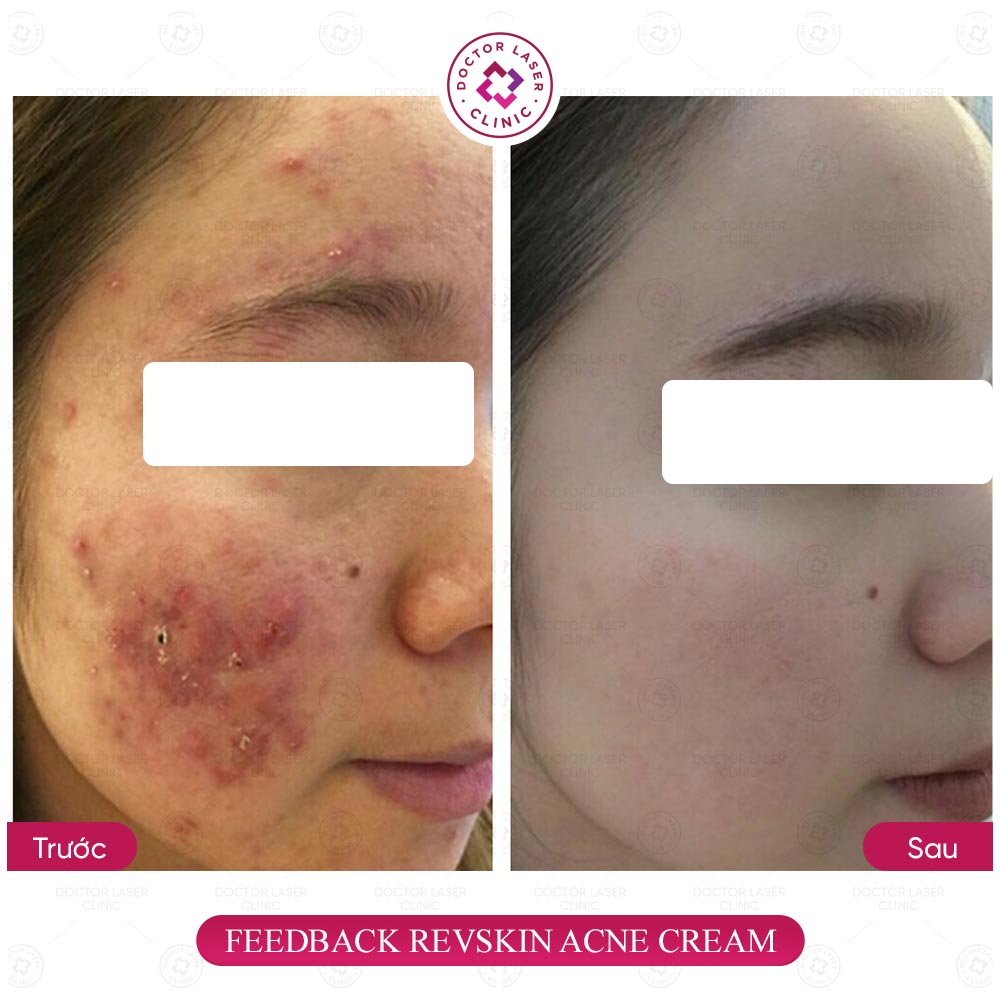 feedback acne cream