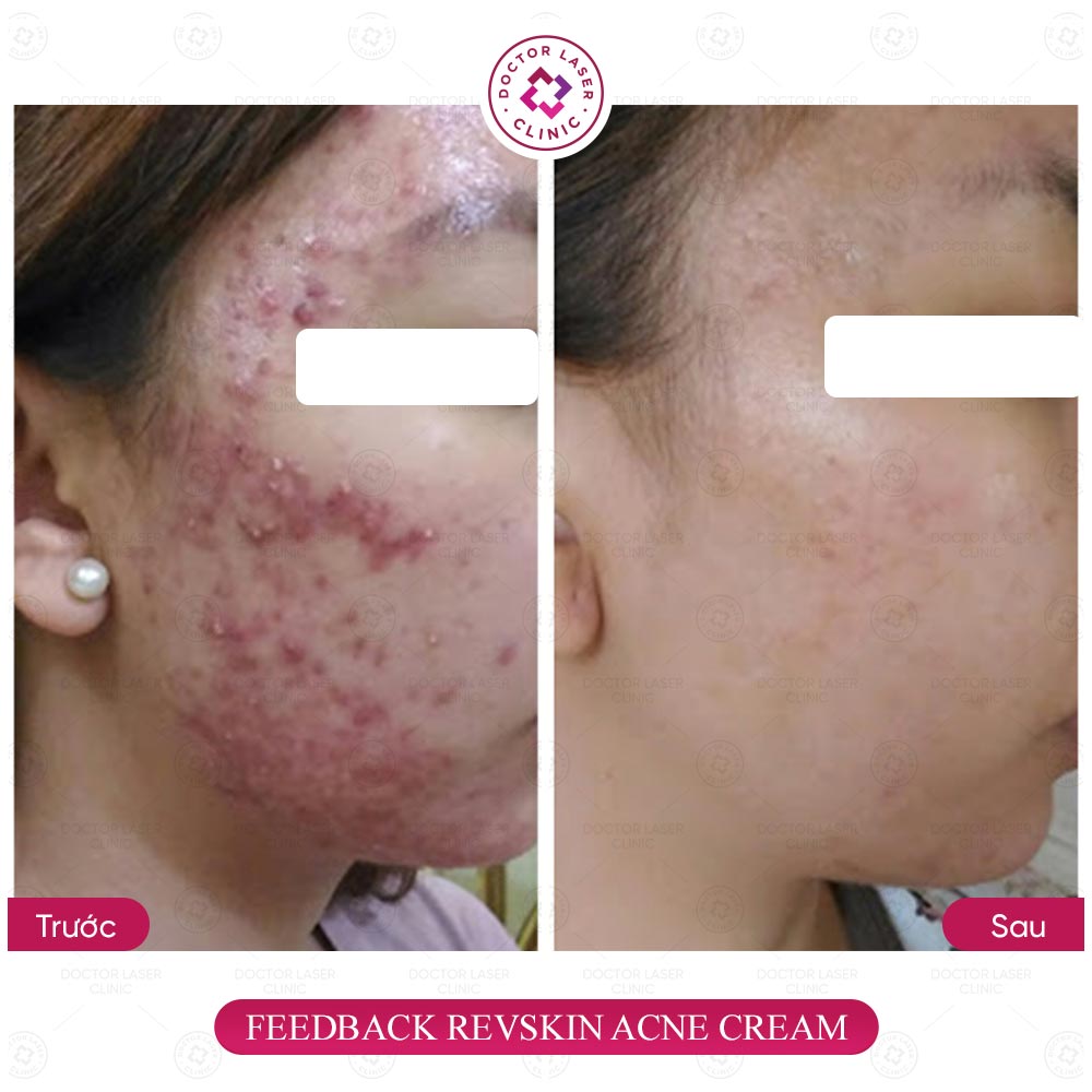 feedback acne cream