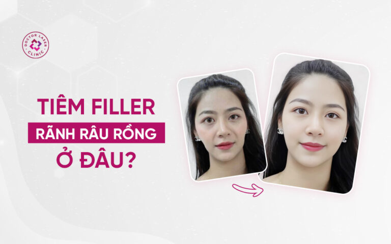 Tiêm Filler Rãnh Râu Rồng Ở Đâu?