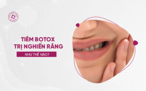 tiêm botox trị nghiến răng