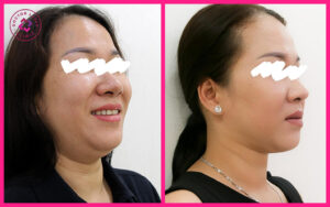 Cách làm tan nọng cằm hiệu quả