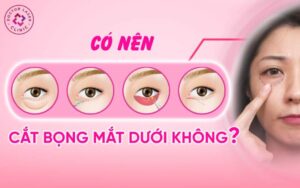 Có nên cắt bọng mắt dưới không?