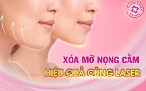 Xóa Mỡ Nọng Cằm Hiệu Quả Cùng Laser