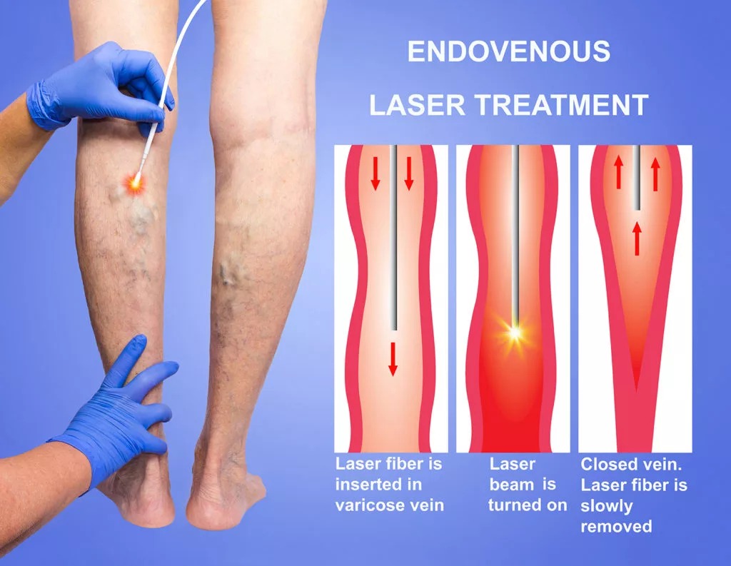 Điều trị bằng Phương pháp Laser Endovenous Therapy (EVLT)