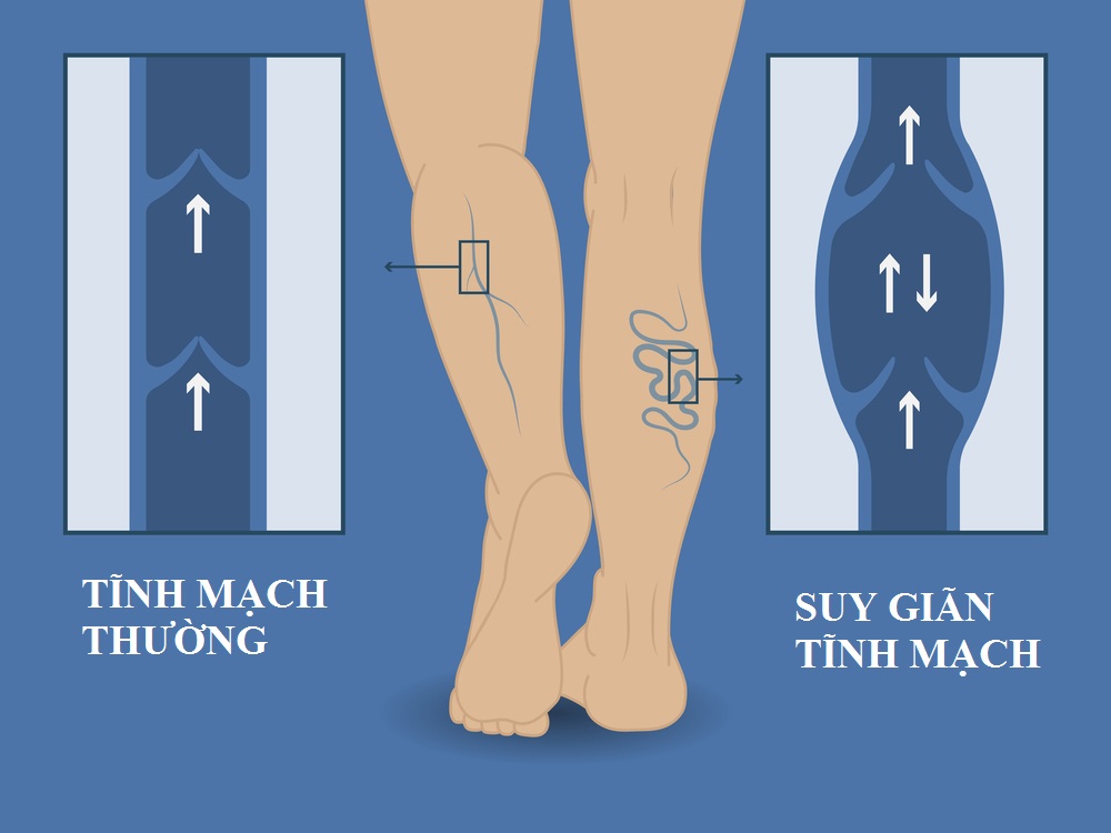 Cách triệu chứng của bệnh tĩnh mạch chân