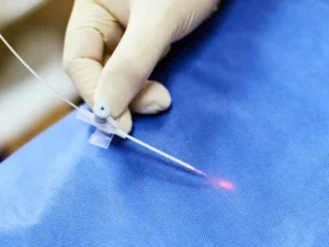 Điều trị giãn tĩnh mạch bằng Laser
