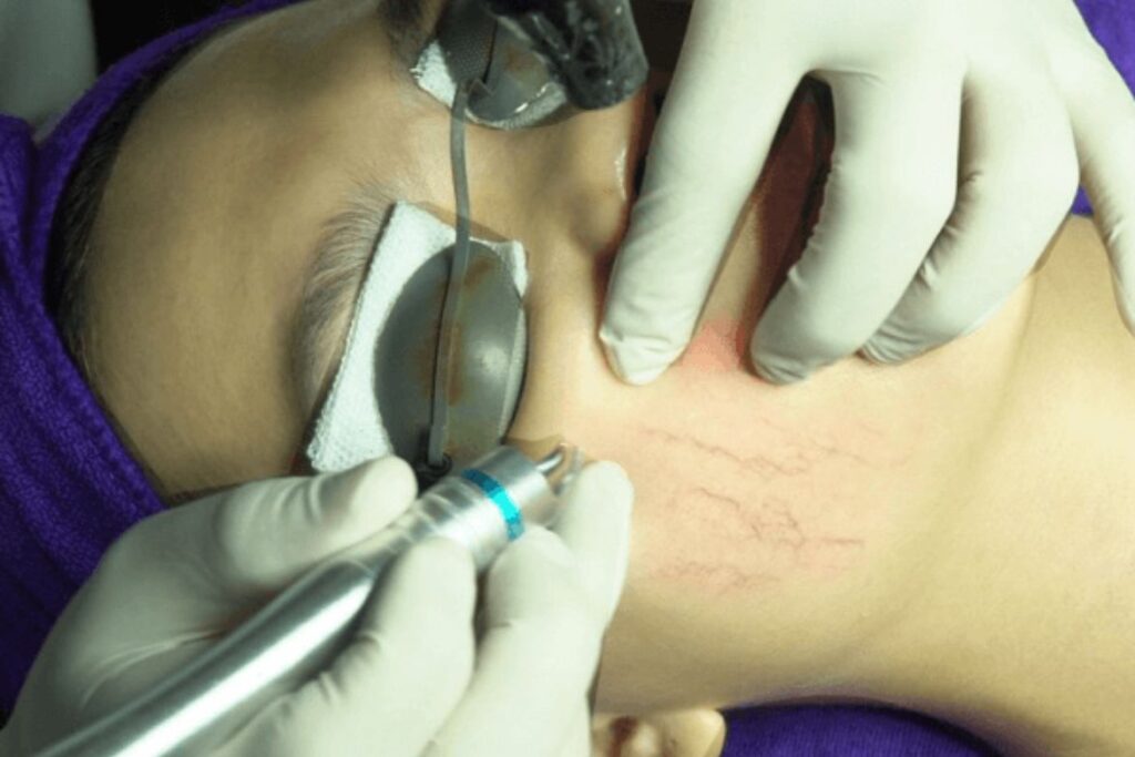 Bác sĩ tại Doctor Laser đang điều trị giãn mao mạch.