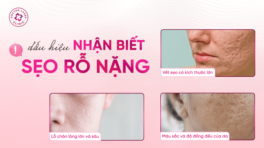 Dấu hiệu nhận biết sẹo rỗ nặng