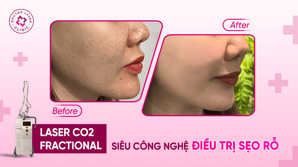 Laser CO2 Fractional điều trị sẹo rỗ