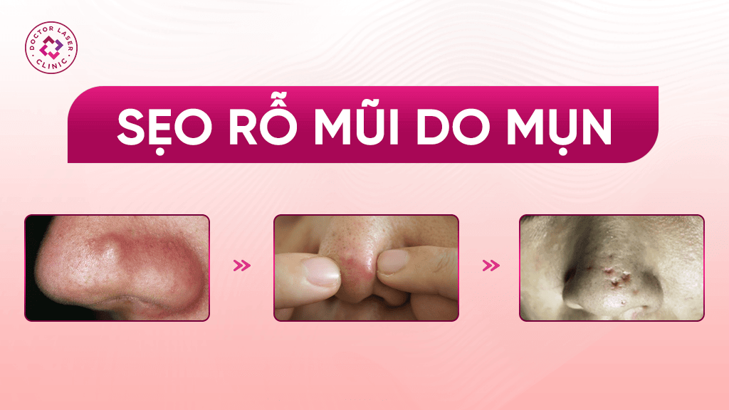 Sẹo rỗ mũi do mụn