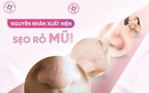 Nguyên nhân gây sẹo rỗ ở mũi