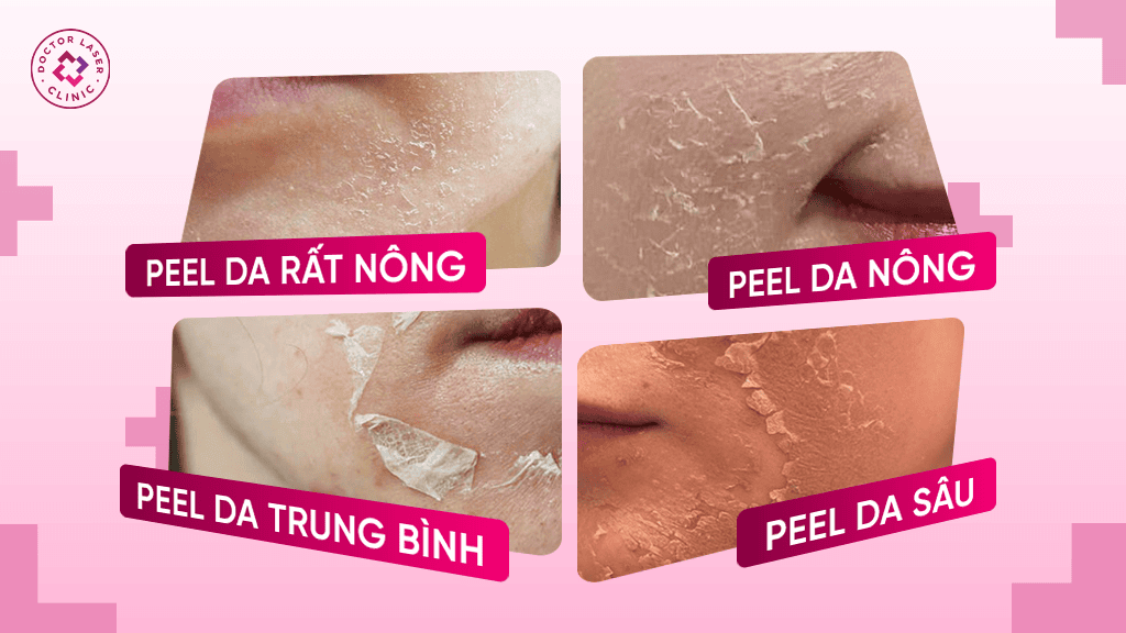 Các mức độ peel da