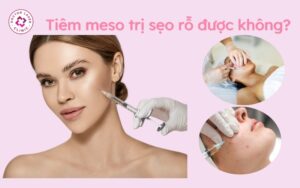 Tiêm meso trị sẹo rỗ