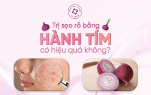 3 cách trị sẹo rỗ bằng hành tím cực kỳ hiệu quả