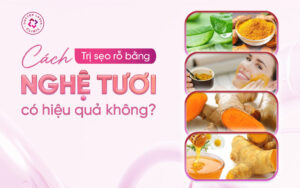 cách trị mụn bằng nghệ tươi hiệu quả tại nhà