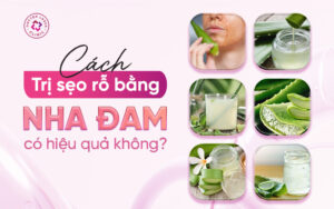 Cách trị sẹo rỗ bằng nha đam an toàn